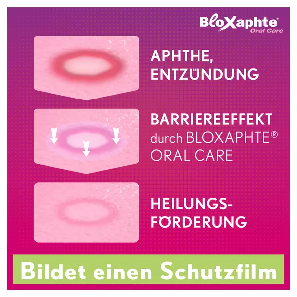 Bloxaphte Oral Care Mundspülung bei Aphthen und Verletzungen im Mund 100 ml
